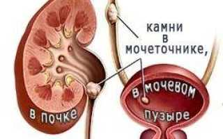 Почечная колика что делать