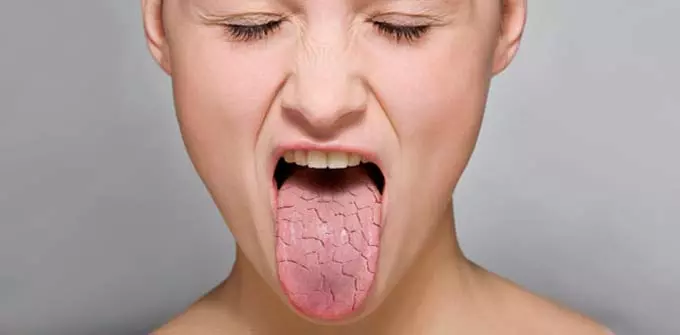 Симптоматические проявления недостаточного слюноотделения сухой язык