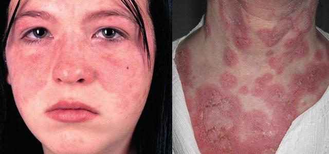 Болит голова сыпь температура