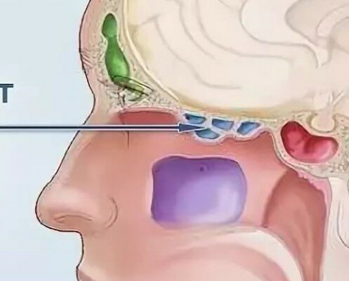 после насморка болит переносица и голова