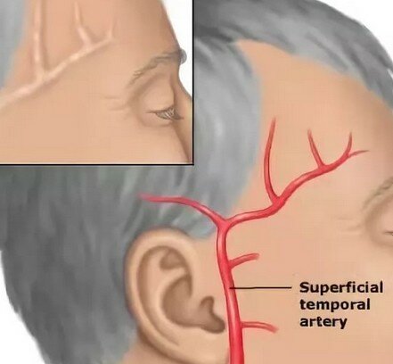 Почему болит правый висок и правая часть головы