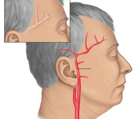 Почему болит левый висок головы и глаз что