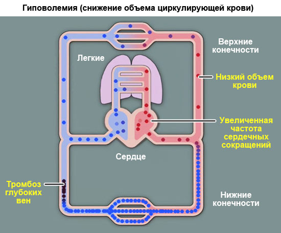 гиповолемия