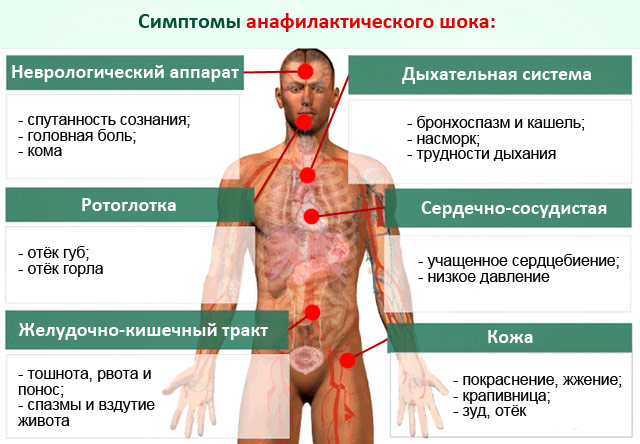 симптомы анафилактического шока