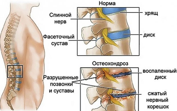 Если крутит ноги и болит спина