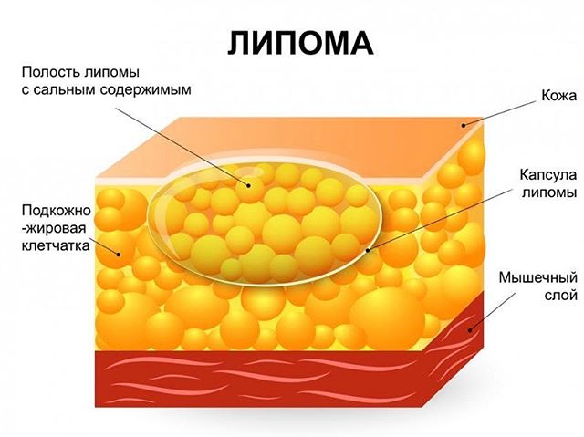 Опухоль на спине под кожей болит