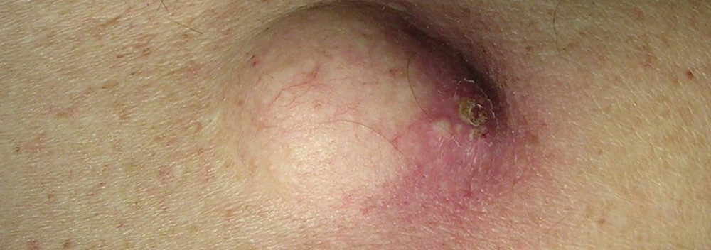 Опухоль на спине под кожей болит