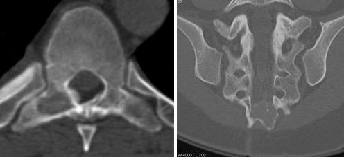 Энхондрома