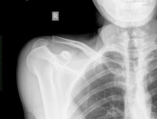 Болит спина справа у ключицы