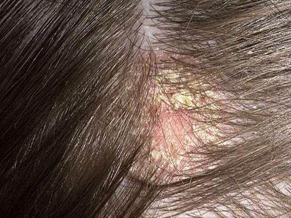 Красное пятно на голове не болит не чешется