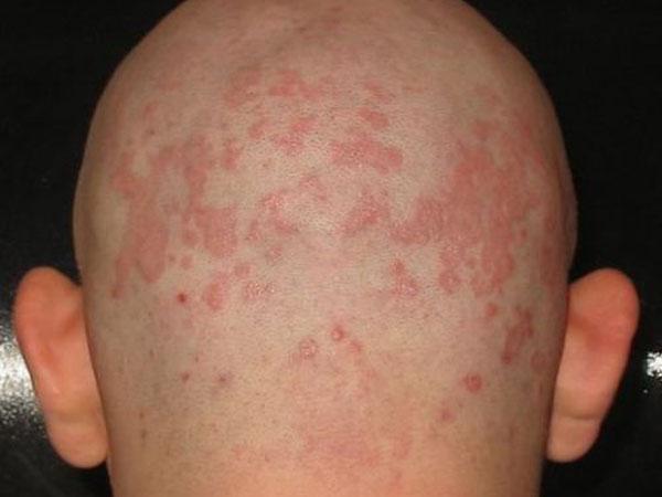 Красное пятно на голове не болит не чешется