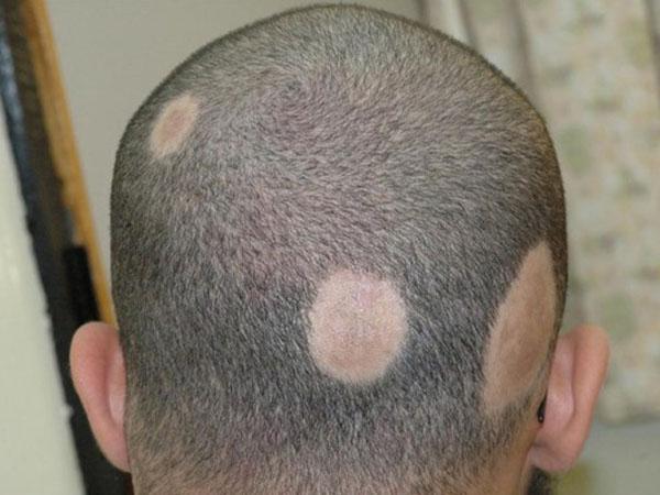 Красное пятно на голове не болит не чешется