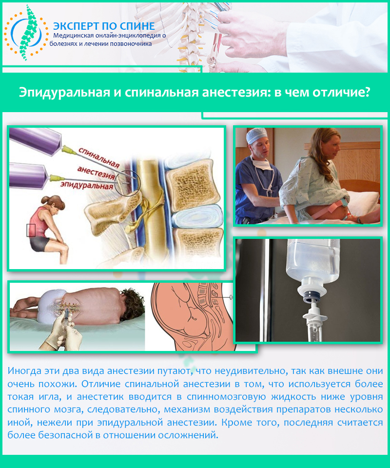 Эпидуральная и спинальная анестезия: в чем отличие?