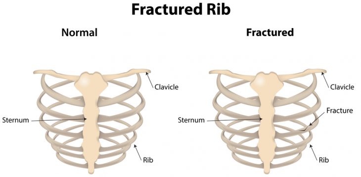Перелом ребер болит спина