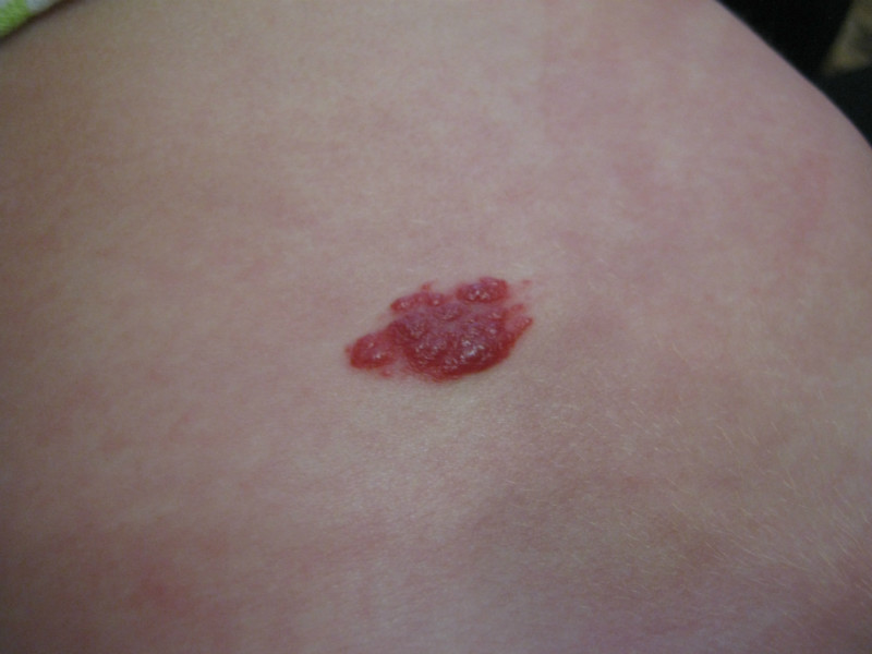 Гемангиома