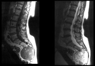 Опухоль на спине под кожей болит