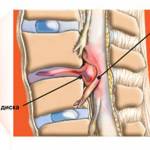 после эпидуральной анастезии болит спина