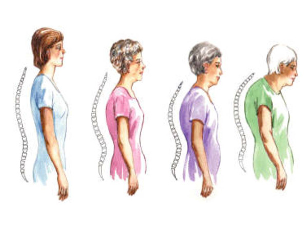 возрастной кифоз