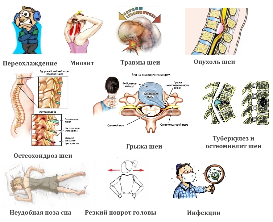 Частые причины боли в шее Частые причины боли в шее