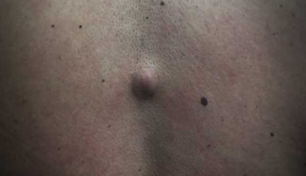 Шишка на позвоночнике