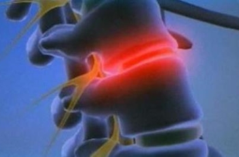 Хрустнул спиной теперь болит