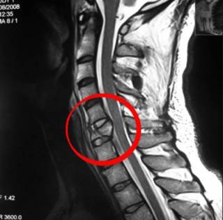 Хрустнул спиной теперь болит