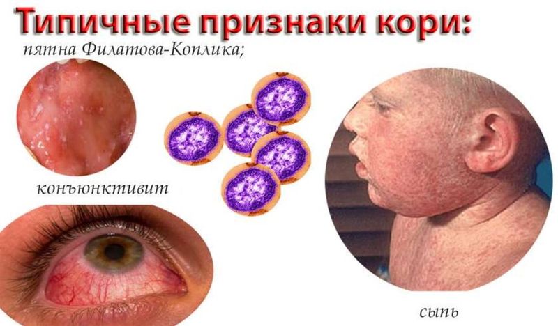 Болит голова сыпь температура