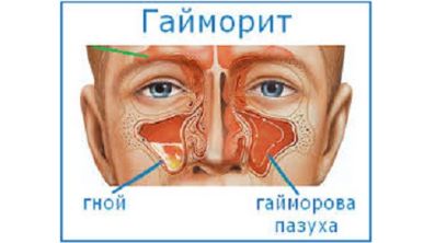 температура и болит спина причины
