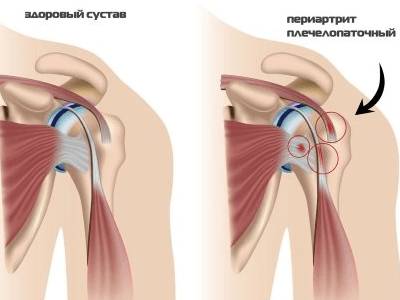 Болит спина отдает в руку и шею