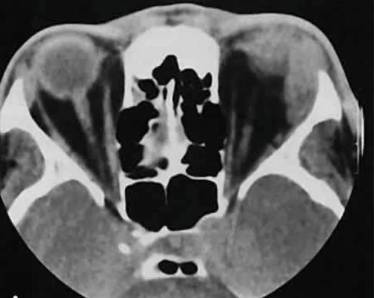 После насморка болит голова и шея