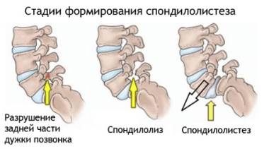 Болит ночью спина в грудном отделе