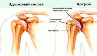 Болит спина справа у ключицы