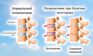 Если крутит ноги и болит спина