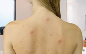 Большие воспаленные прыщи на женской спине