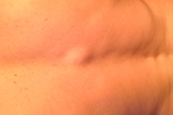 Опухоль на спине под кожей болит