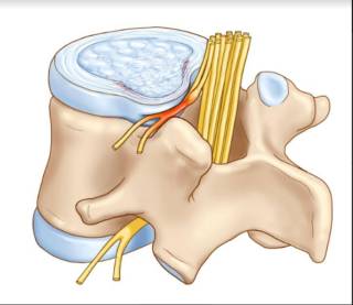 Хрустнул спиной теперь болит