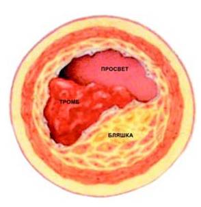 энцефалопатия