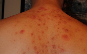 Красные прыщи на спине