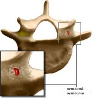 Опухоль на спине под кожей болит