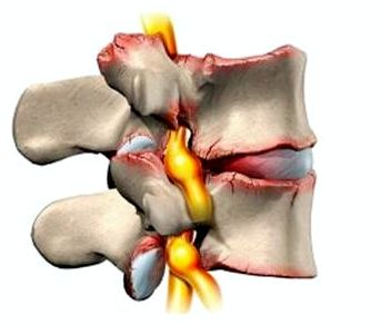 Болит спина отдает в руку и шею