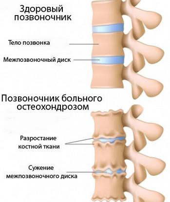 Лечение резких болей в спине и пояснице