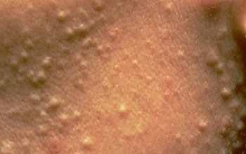 Подкожные прыщи на спине