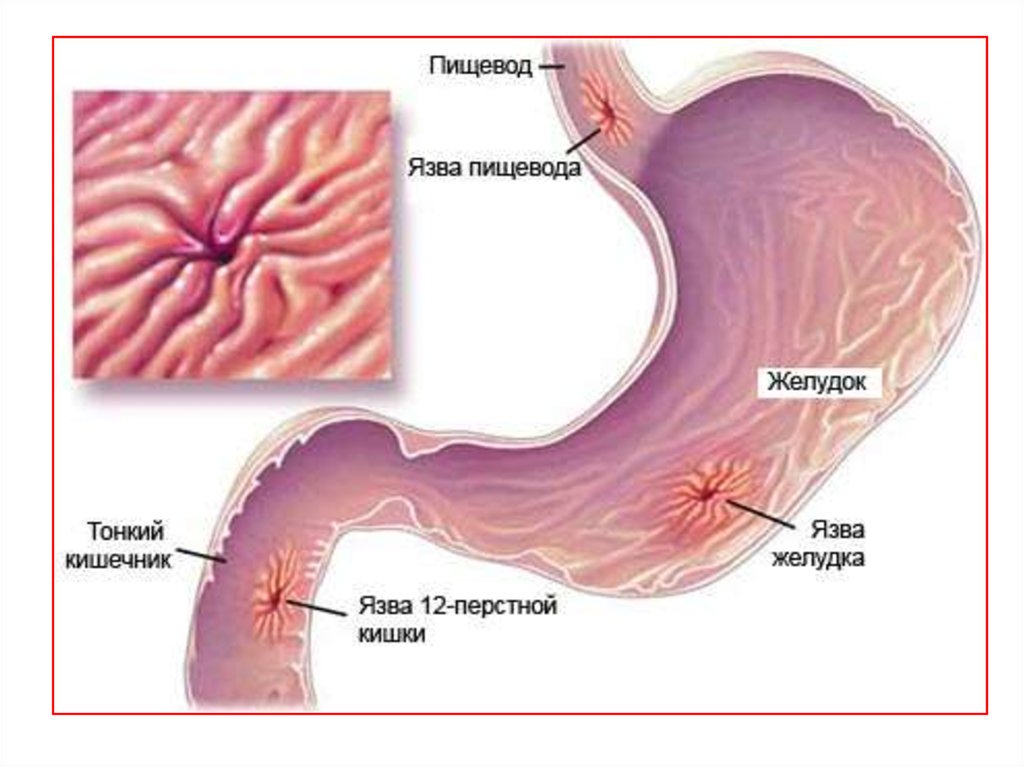 Подтверждает язвенную болезнь тот факт, что становится легче, если выпить «Омез» или «Ранитидин» после рвоты, а также, если приложить к спине теплую грелку