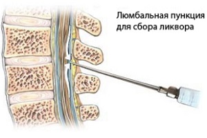 болит спина в месте пункции