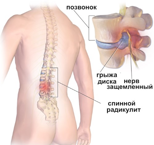 Радикулит Радикулит