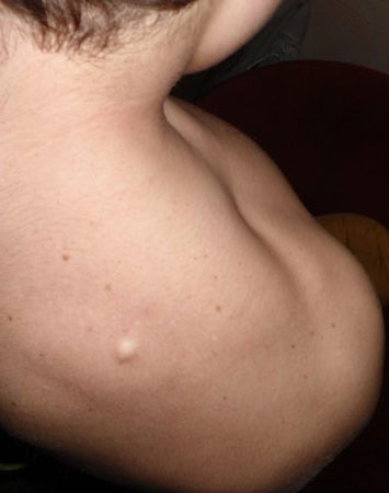 Подкожная шишка на спине болит что это может быть