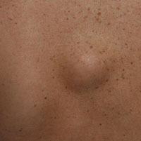 Появилась шишка под кожей на спине, что это?