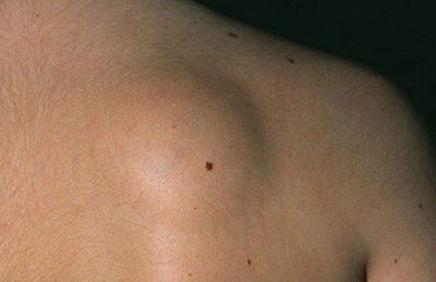 Подкожная шишка на спине болит что это может быть