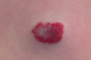 Гемангиома Подкожная шишка на спине болит что это может быть