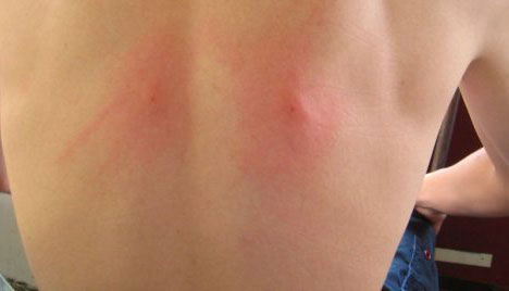 Красное уплотнение под кожей Уплотнение на спине под кожей возле позвоночника